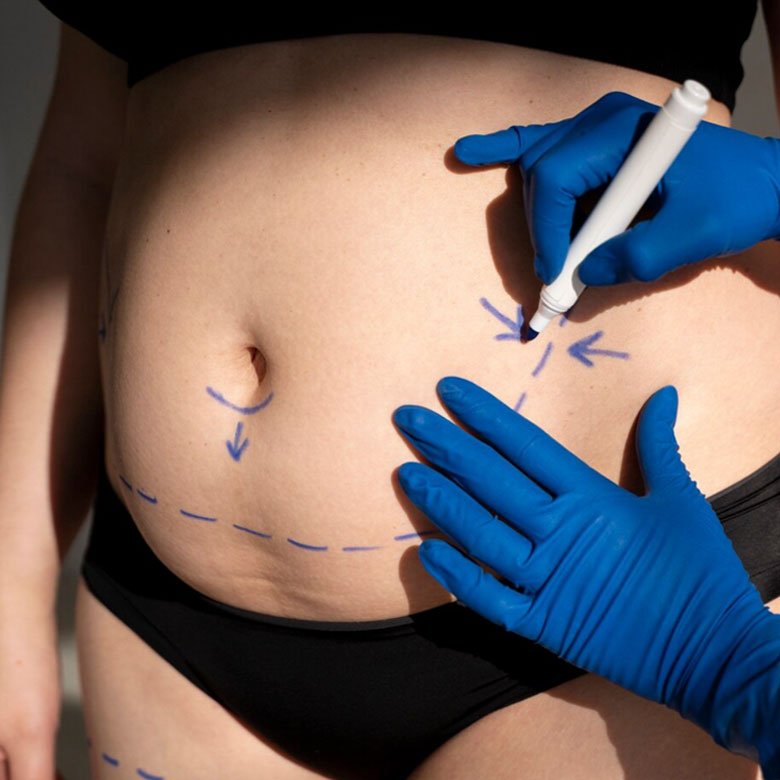 Abdominoplastia - Dra. Cynthia Montenegro