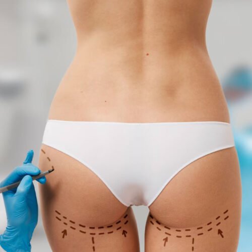 Gluteoplastia - Dra. Cynthia Montenegro