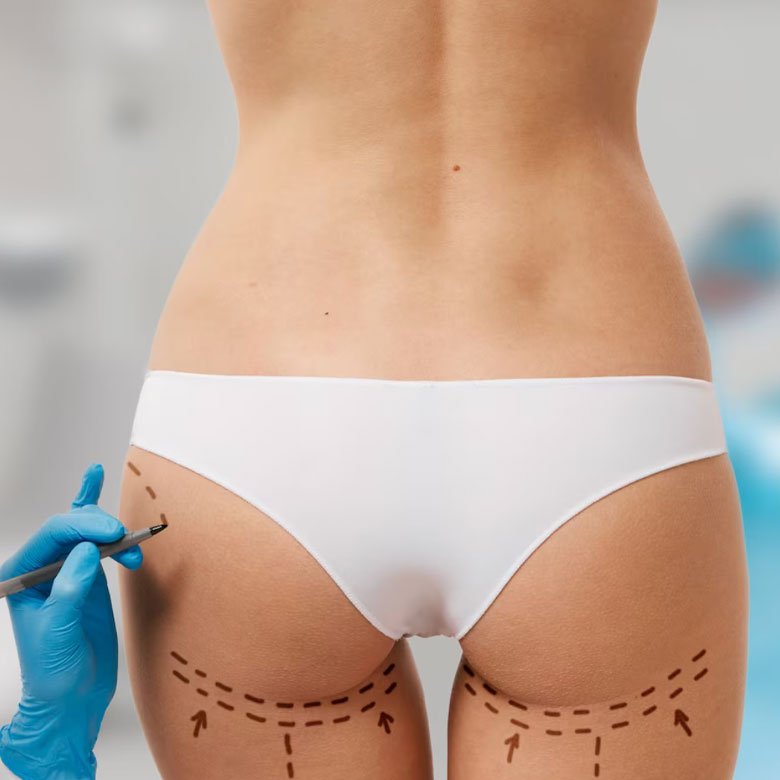 Gluteoplastia - Dra. Cynthia Montenegro