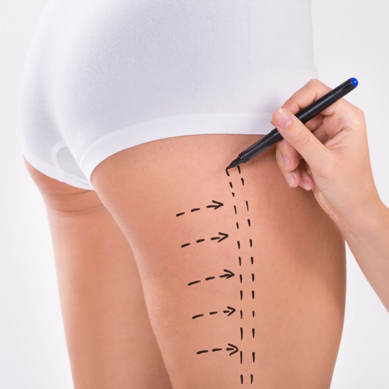 Lifting de Piernas - Dra. Cynthia Montenegro