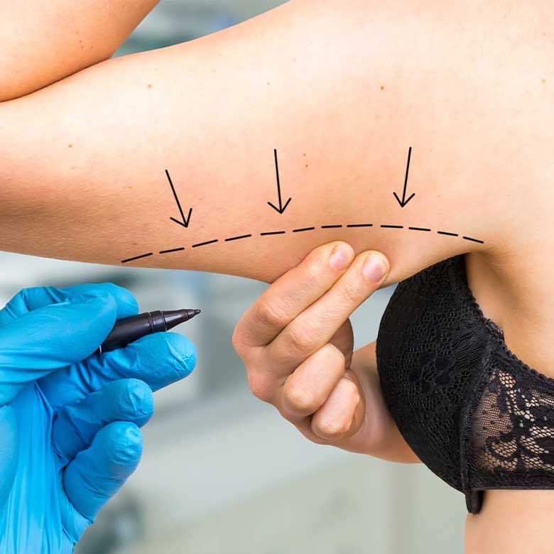 Lifting de Brazos - Dra. Cynthia Montenegro