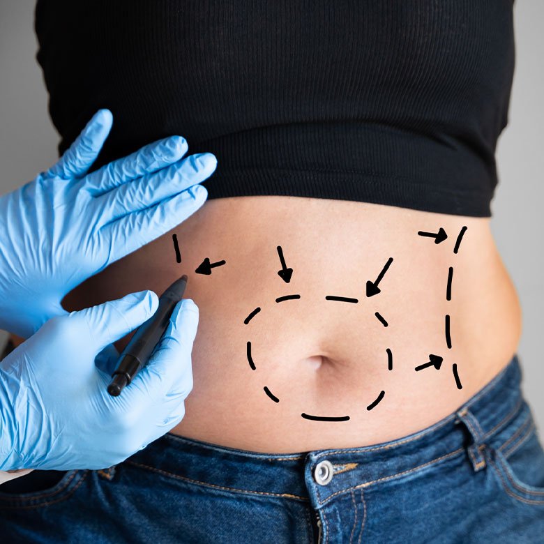 Liposucción con VASER y/o RENUVION - Dra. Cynthia Montenegro