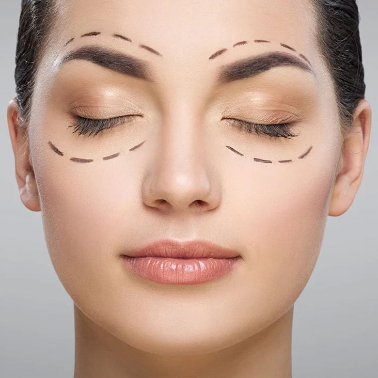 Blefaroplastia-Dra-Cynthia-Montenegro-780x780