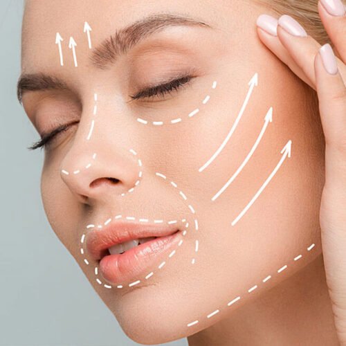 lifting facial en lima dra cynthia montenegro