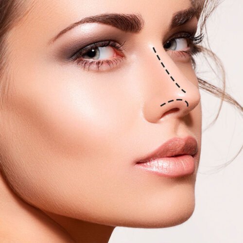 rinoplastia dra cynthia montenegro