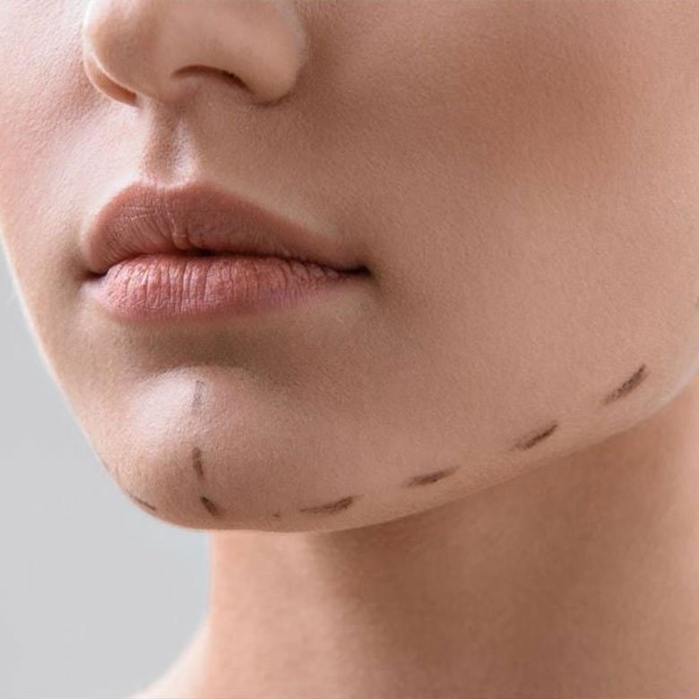 aumento-de-menton-Dra-Cynthia-Montenegro-780x780