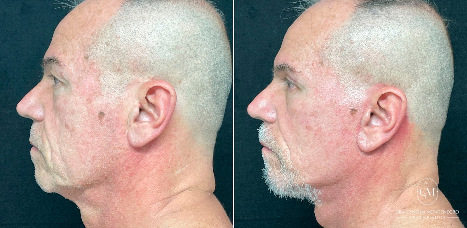 Lifting-Cervicofacial Caso-2-Dra--Cynthia-Montenegro