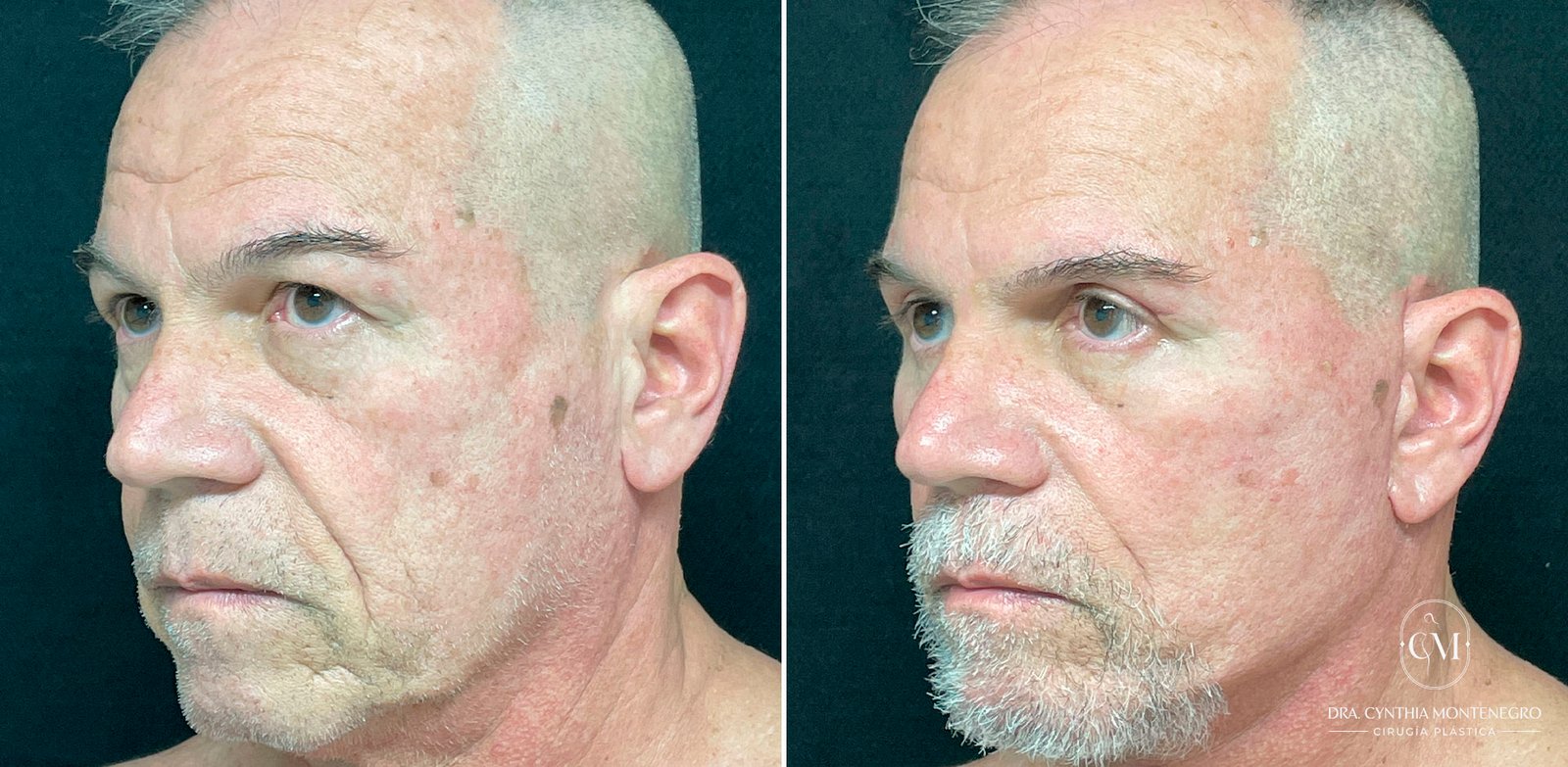 Lifting-Cervicofacial Caso-2-Dra--Cynthia-Montenegro