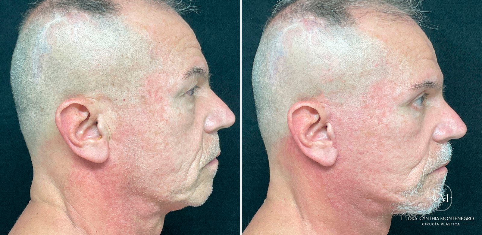 Lifting-Cervicofacial Caso-2-Dra--Cynthia-Montenegro