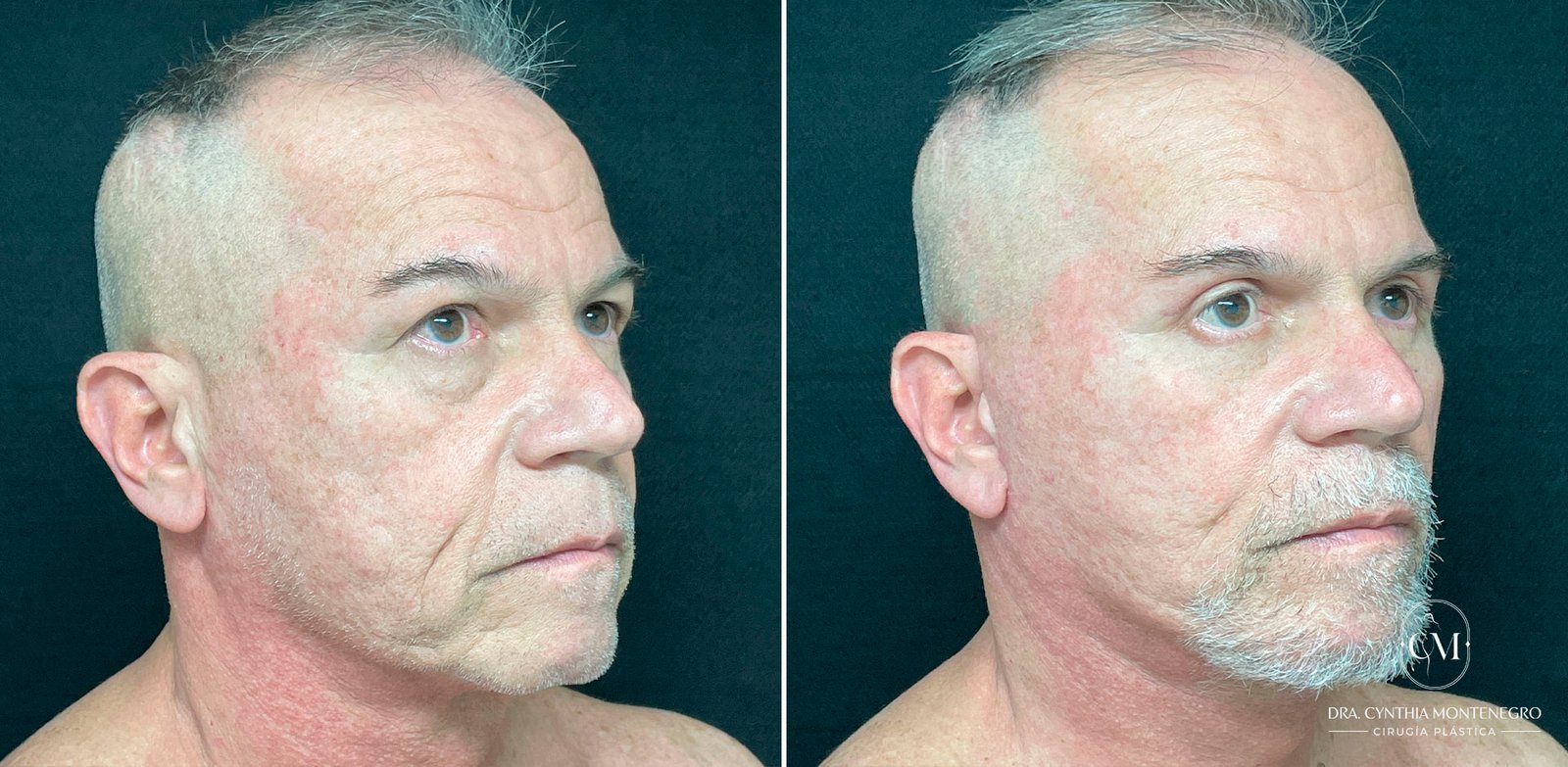 Lifting-Cervicofacial Caso-2-Dra--Cynthia-Montenegro