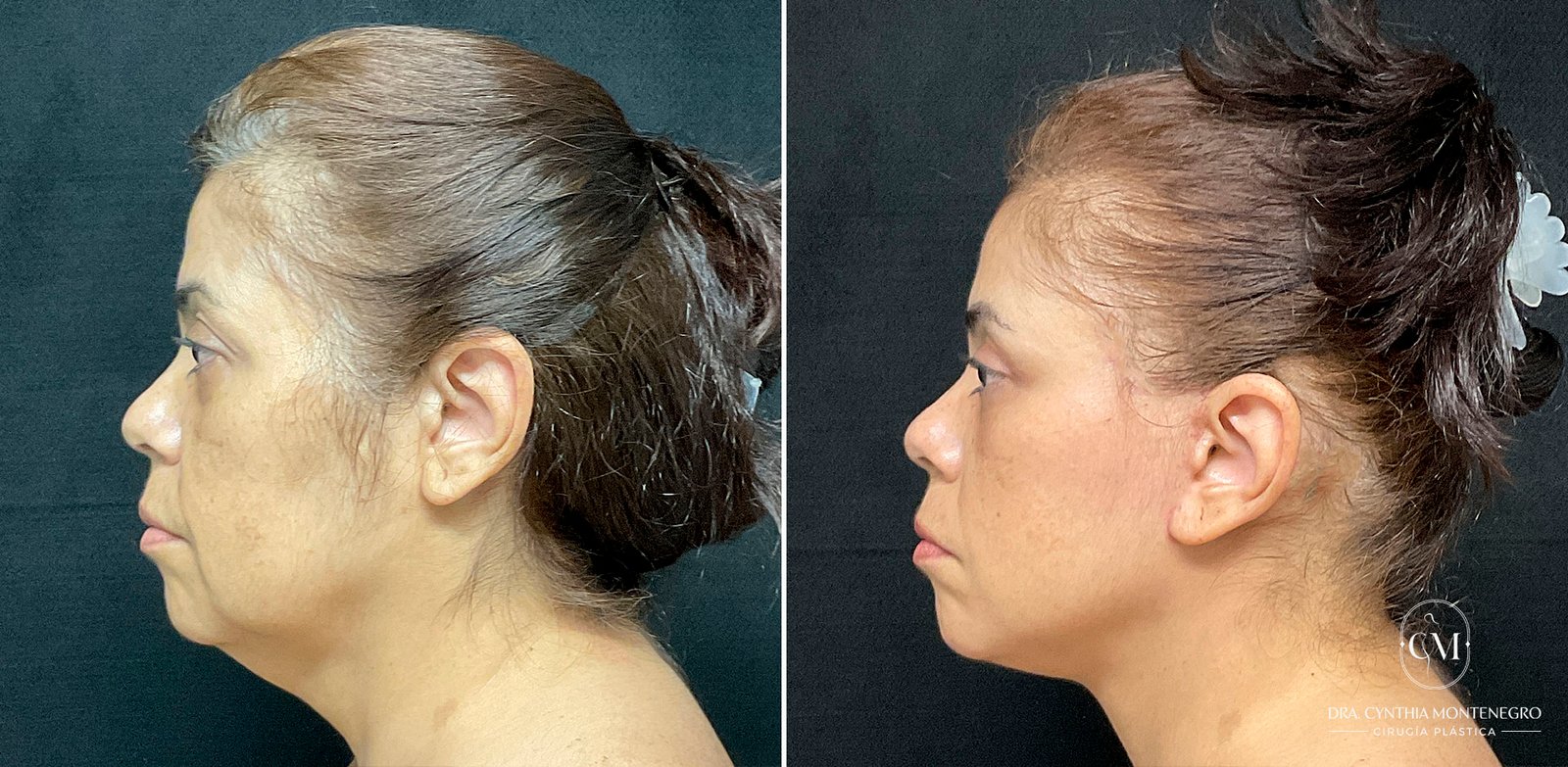 Lifting cervicofacial femenino - Dra. Cynthia Montenegro