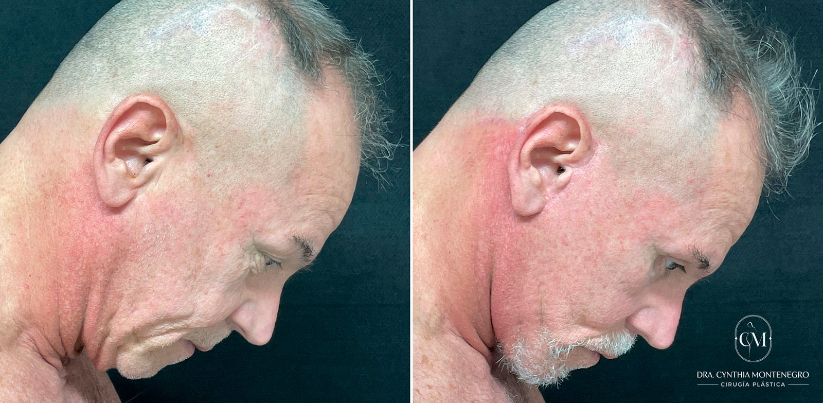 Lifting-Cervicofacial Caso-2-Dra--Cynthia-Montenegro