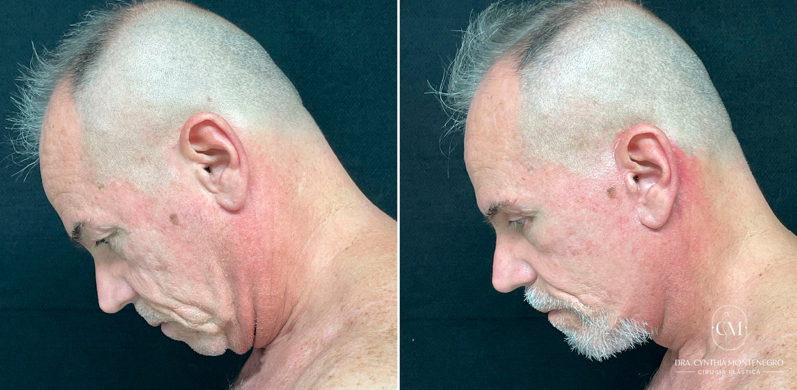 Lifting-Cervicofacial Caso-2-Dra--Cynthia-Montenegro