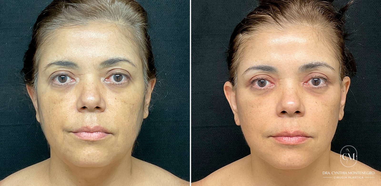 Lifting cervicofacial femenino - Dra. Cynthia Montenegro