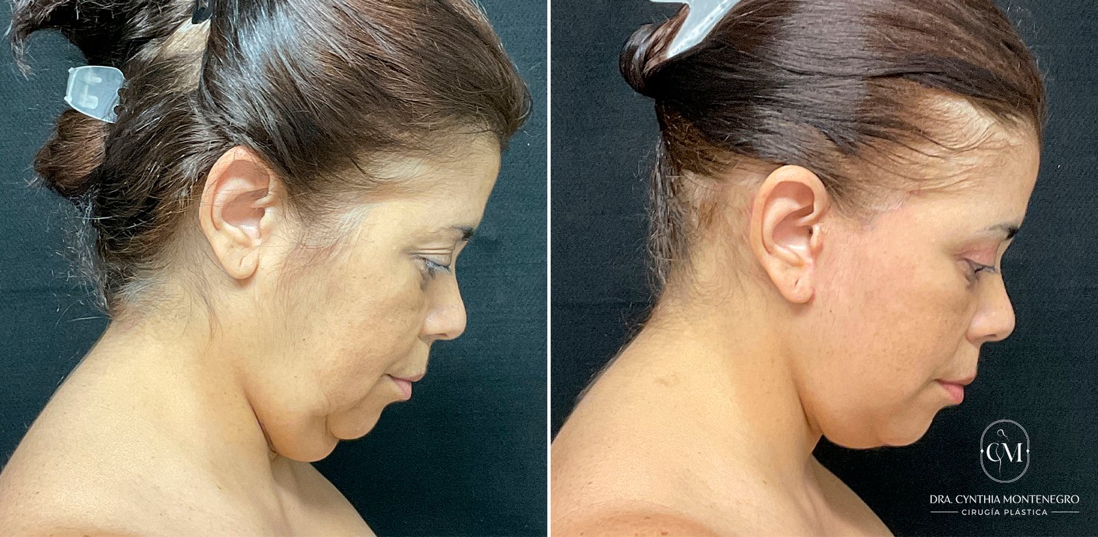 Lifting cervicofacial femenino - Dra. Cynthia Montenegro