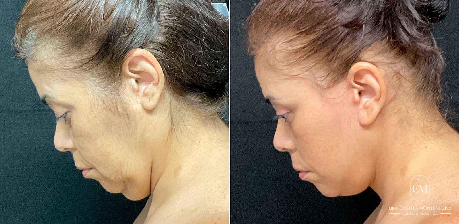 Lifting cervicofacial femenino - Dra. Cynthia Montenegro