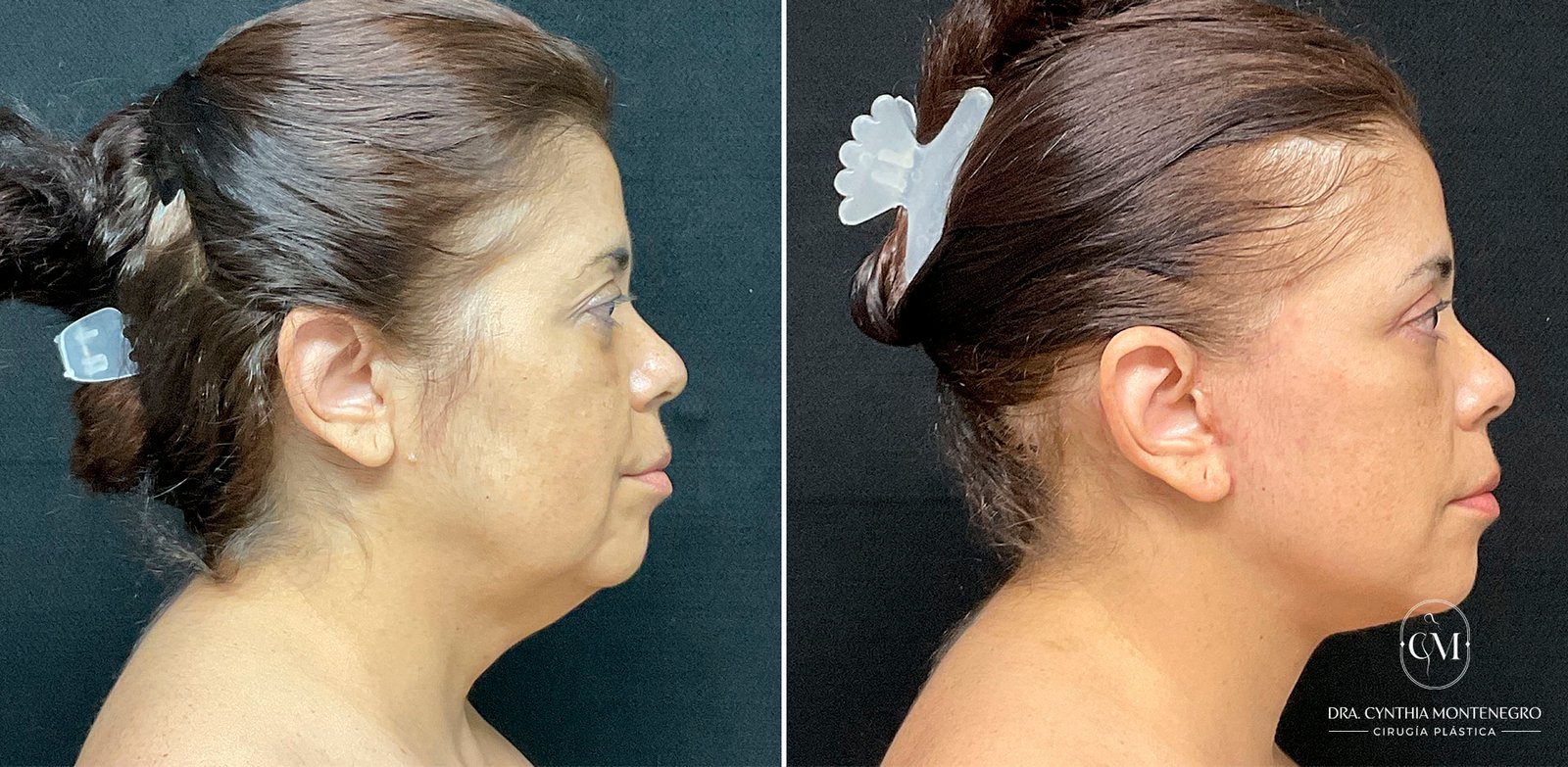 Lifting cervicofacial femenino - Dra. Cynthia Montenegro