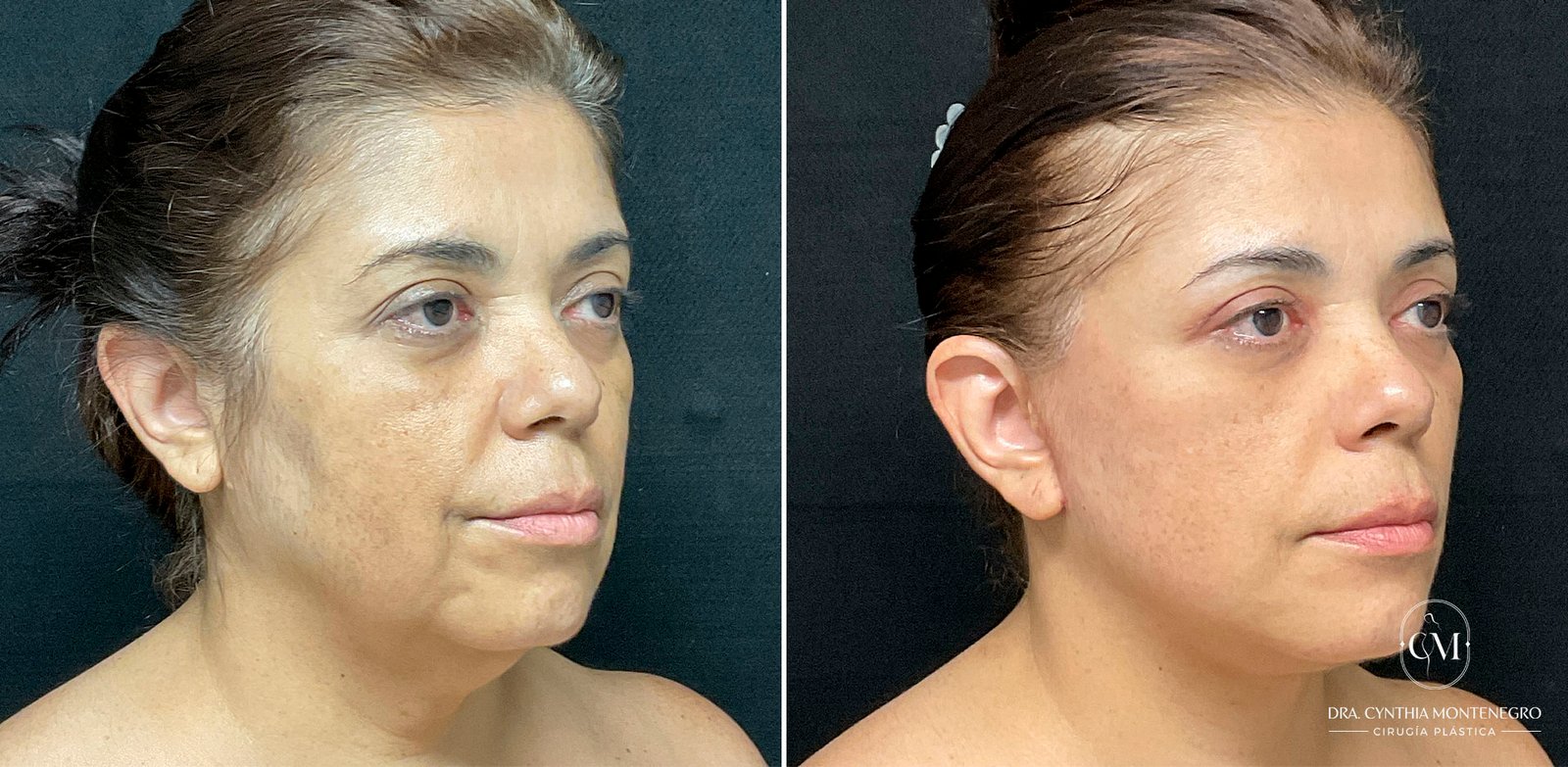 Lifting cervicofacial femenino - Dra. Cynthia Montenegro