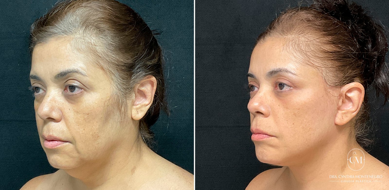 Lifting cervicofacial femenino - Dra. Cynthia Montenegro