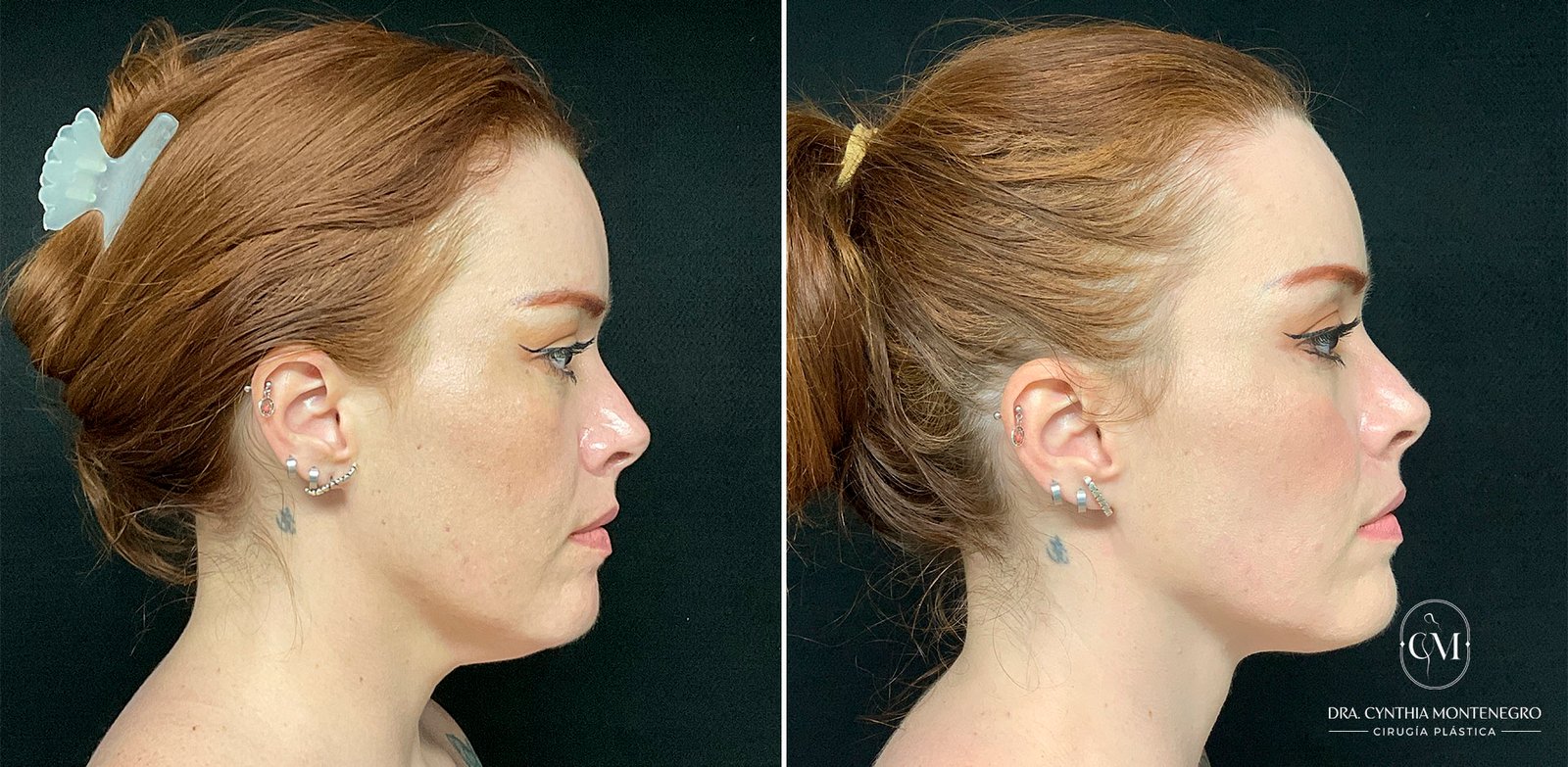 Lipo-de-papada-Caso-1-1-Dra. Cynthia Montenegro