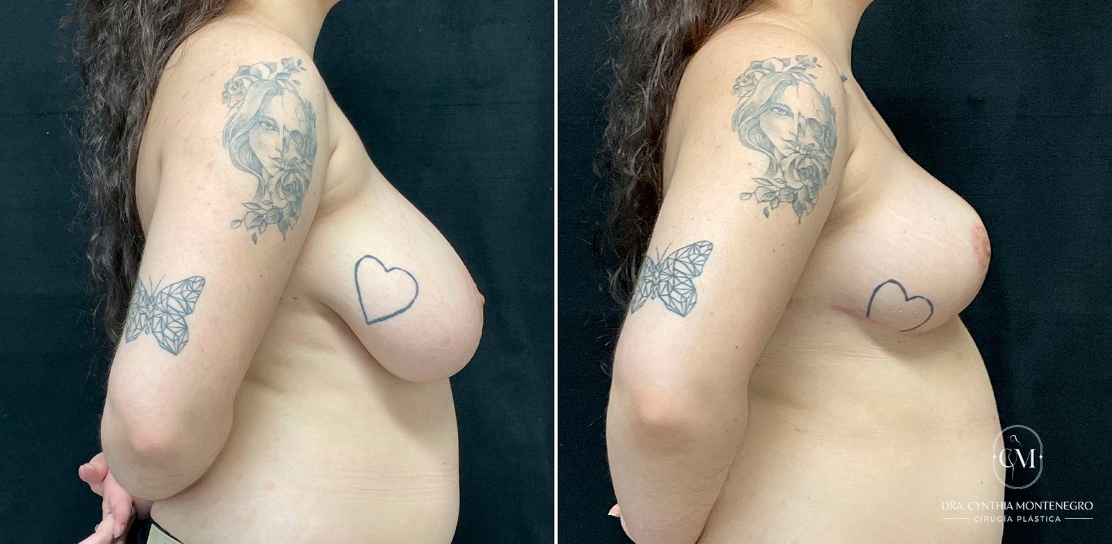 Mamoplastia-Reductora-Caso1-5-Dra. Cynthia Montenegro