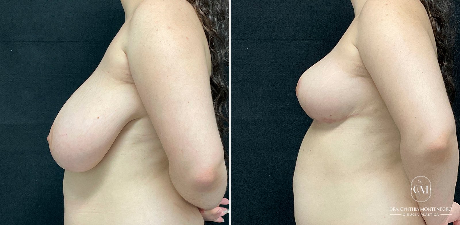 Mamoplastia-Reductora-Caso1-5-Dra. Cynthia Montenegro