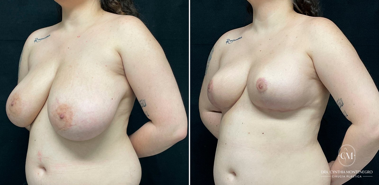 Mamoplastia-Reductora-Caso1-5-Dra. Cynthia Montenegro