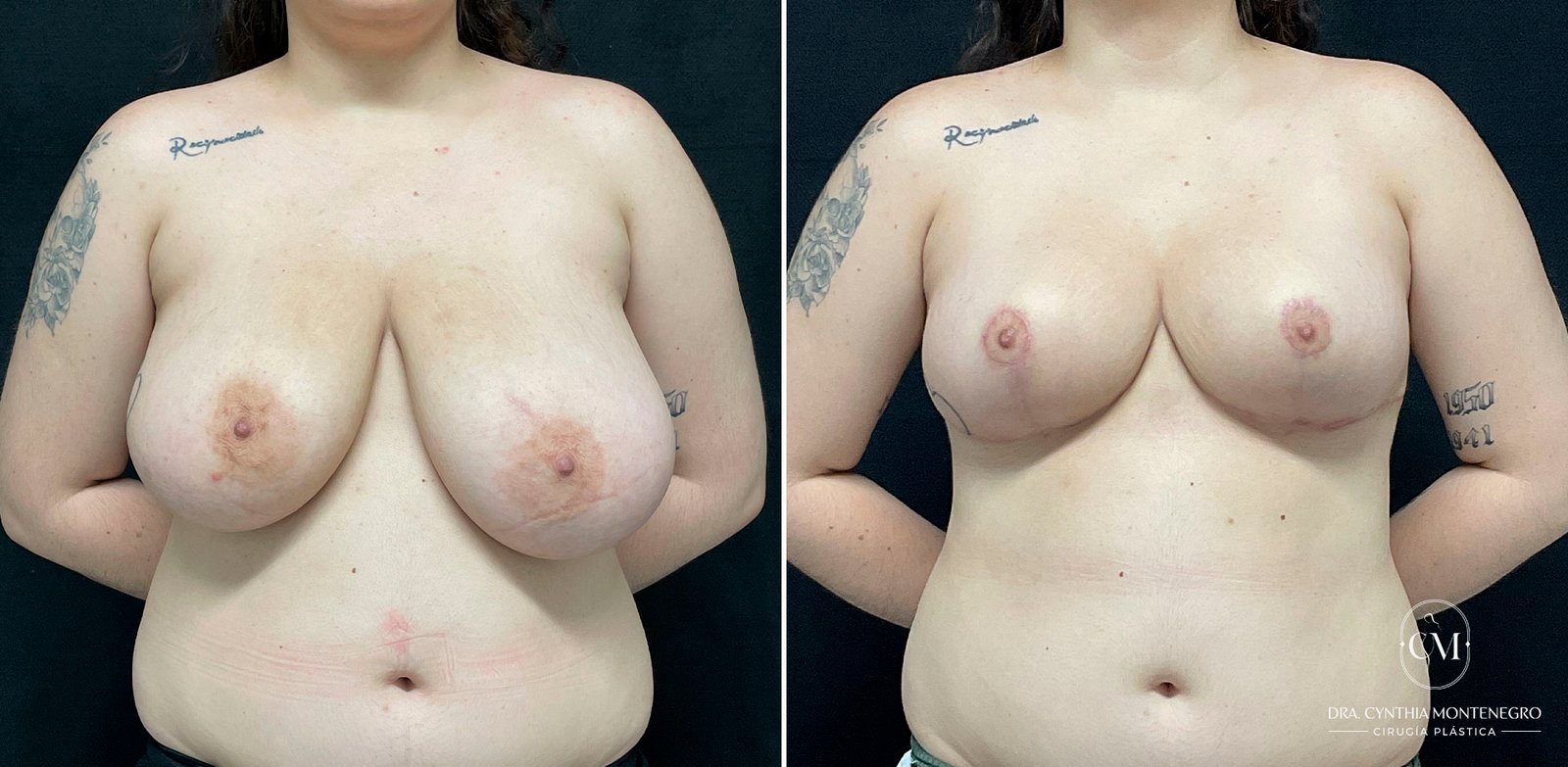 Mamoplastia-Reductora-Caso1-5-Dra. Cynthia Montenegro